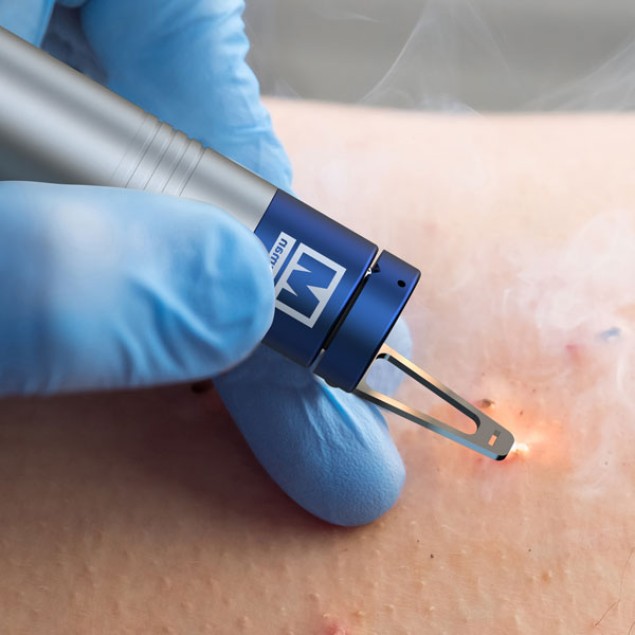 The Blauman 450 nm blue laser — removing a skin lesion
